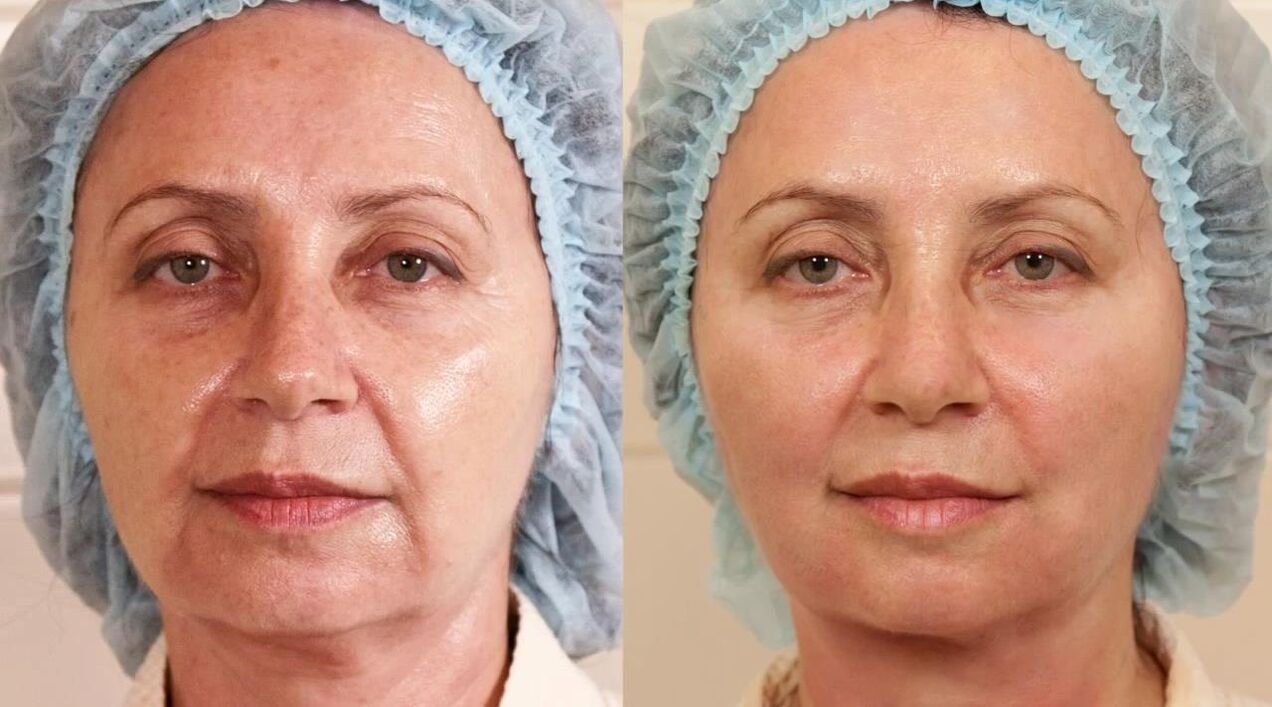 före och efter bilder av ansiktslyftning
