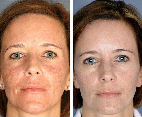 Före och efter fraktionerad ansikts termolys