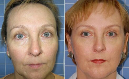 Före och efter fraktionerad laser ansiktsföryngring