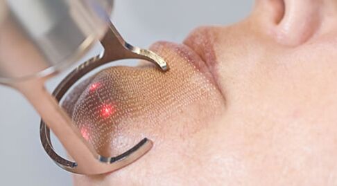Förloppet för proceduren för fraktionerad laser ansiktshudföryngring