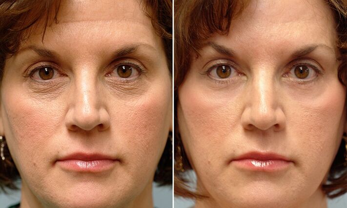 ansikte före och efter laserfraktionerad föryngring